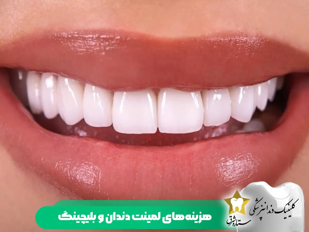 هزینه‌های-بلیچینگ-لمینت دندان