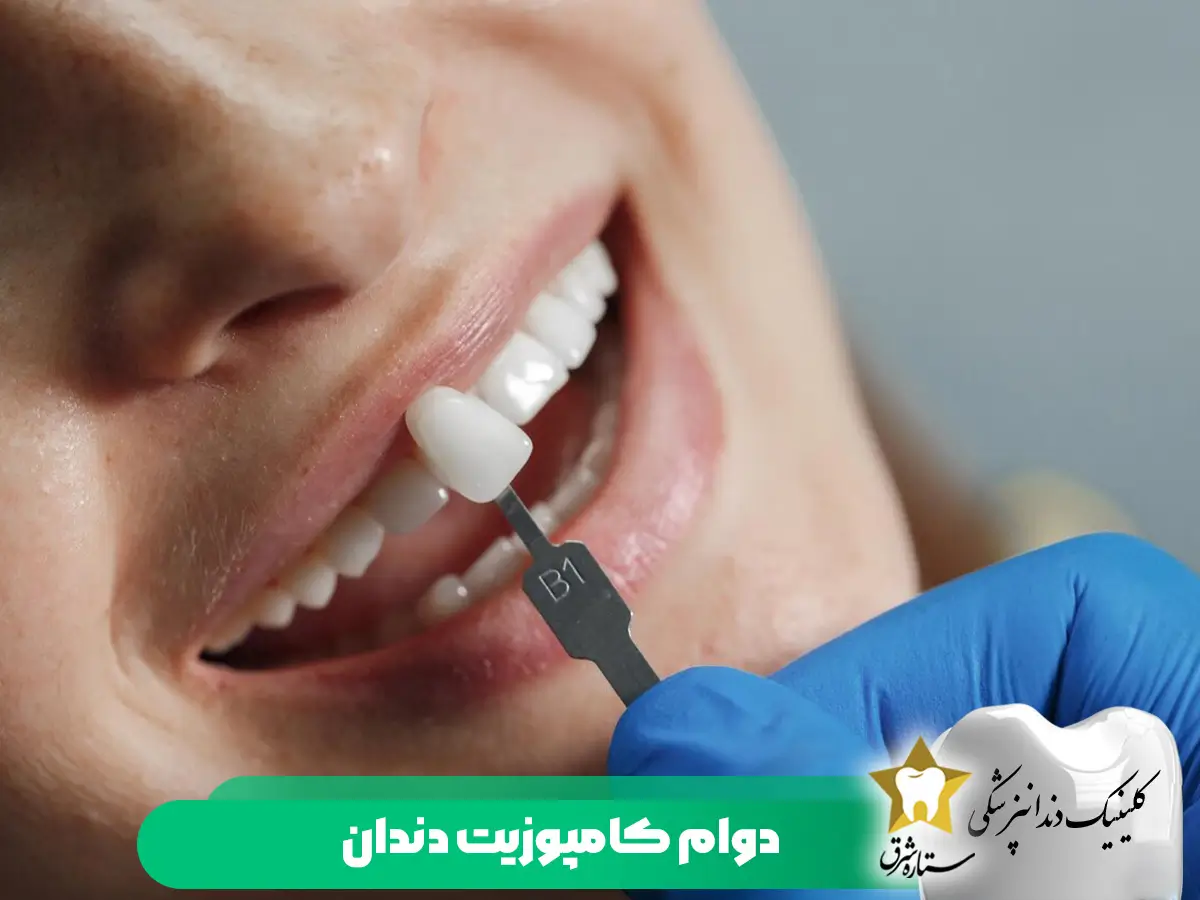 دوام کامپوزیت دندان