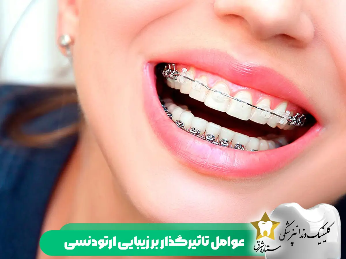عوامل-تاثیرگذار-بر زیبایی-ارتودنسی