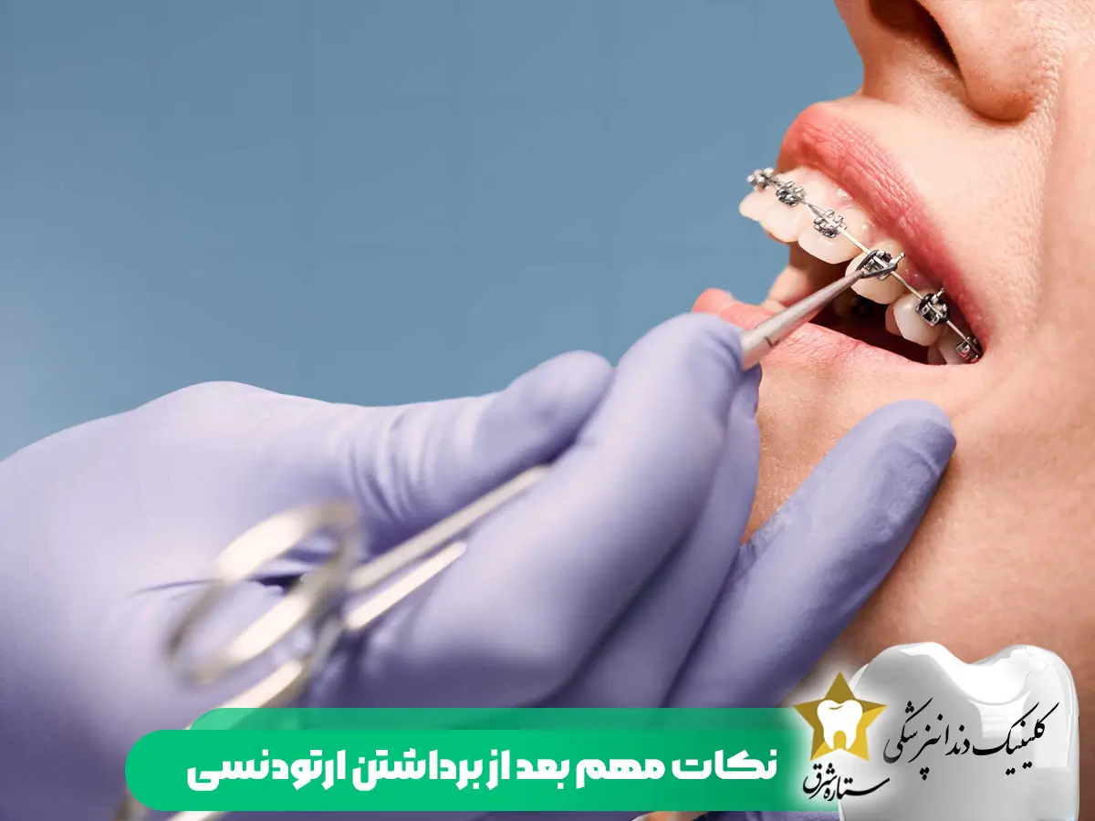 نکات-مهم-بعداز-برداشتن-ارتودنسی