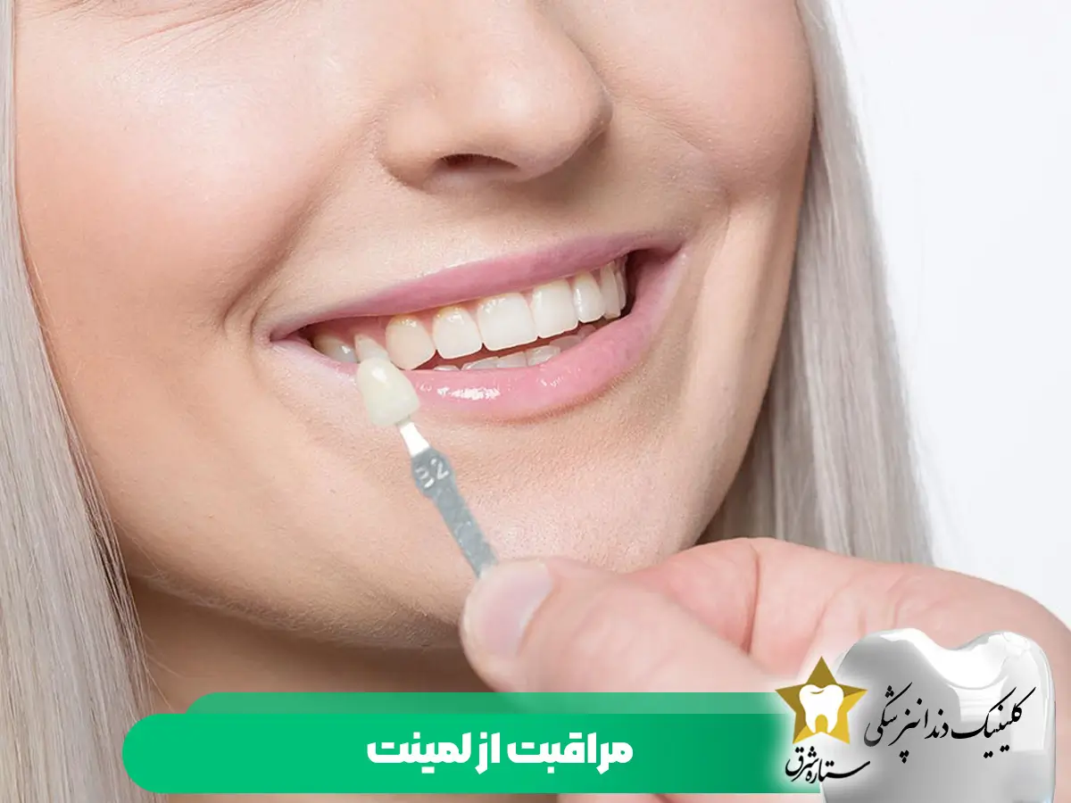 مراقبت-از-لمینت