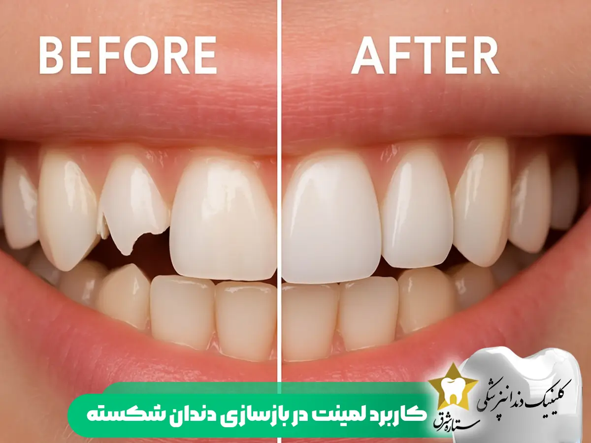 کاربرد لمینت دندان در بازسازی دندان شکسته