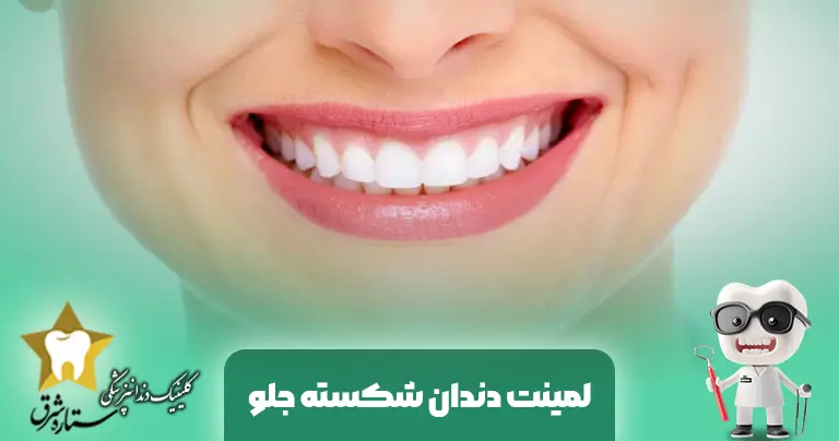 لمینت دندان شکسته جلو