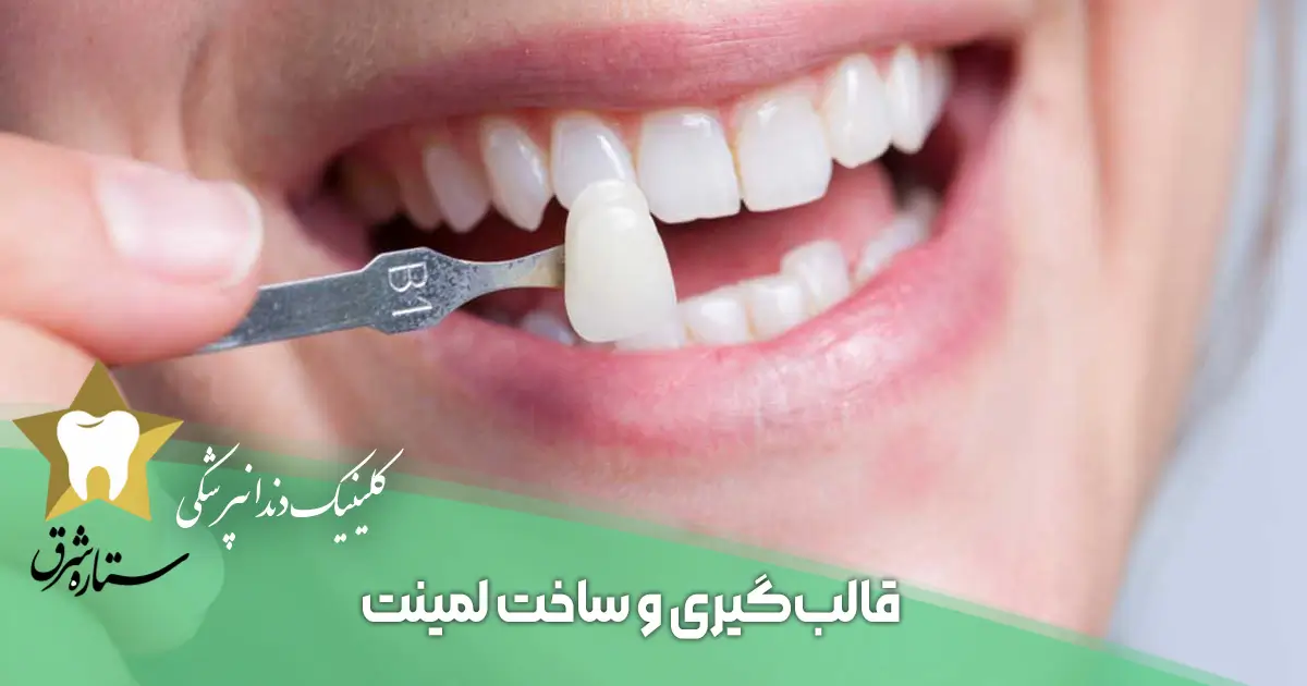 آماده سازی دندان قبل از لمینت