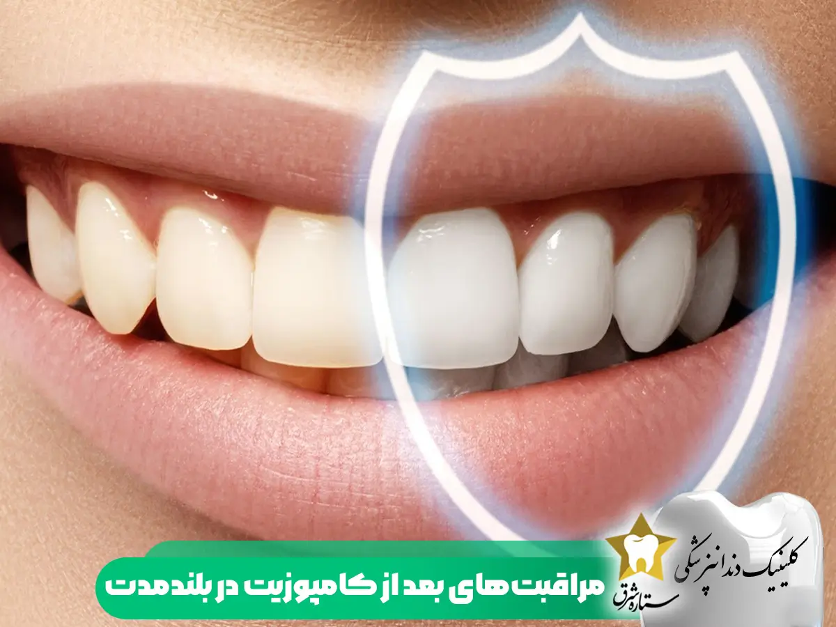 مراقبتهای-بعداز-کامپوزیت-دندان