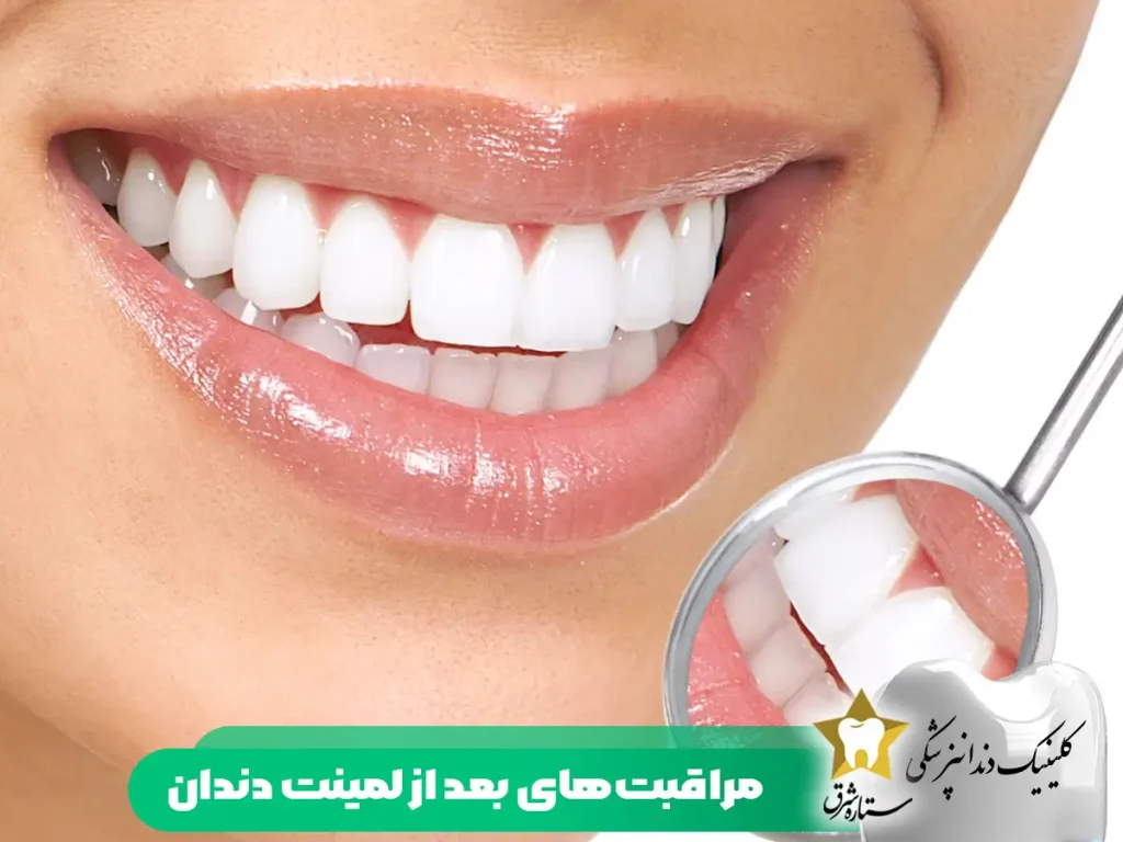 مراقبت‌های بعد از لمینت دندان