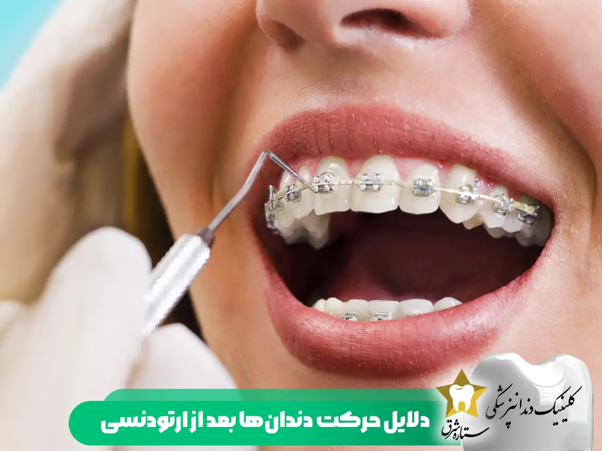 علل-حرکت-دندان ها-بعداز-ارتودنسی