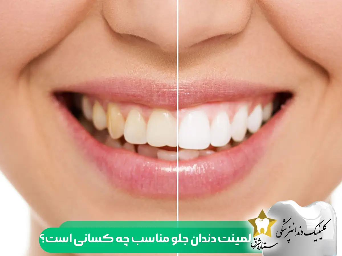 لمینت دندان جلو مناسب چه کسانی است ؟