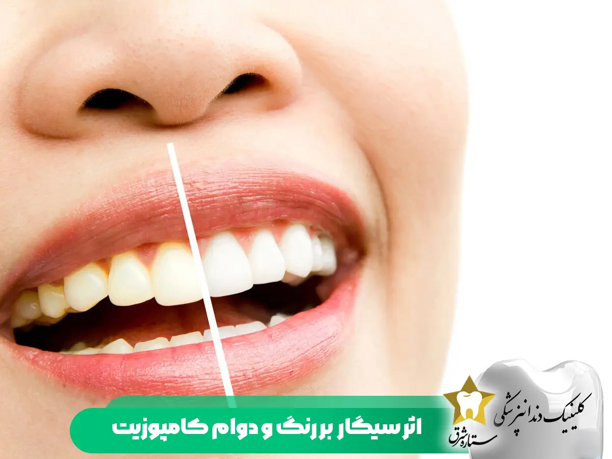 اثر سیگار بر رنگ-دوام-کامپوزیت