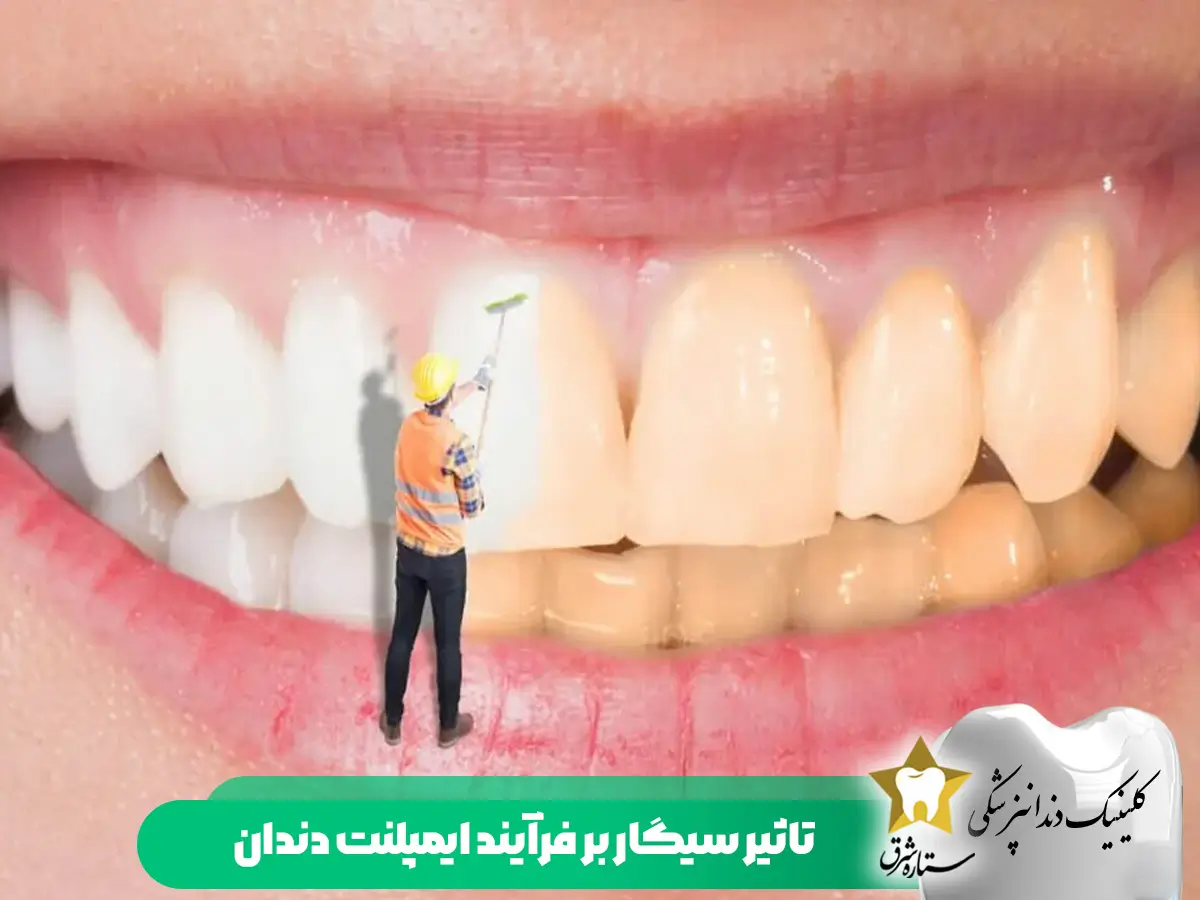 تاثیر سیگار بر فرآیند ایمپلنت دندان