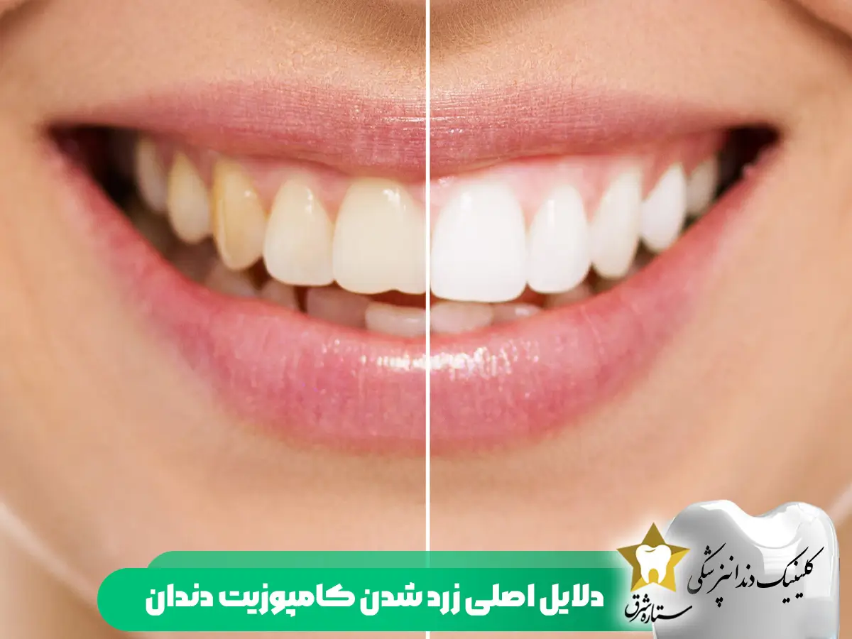 دلایل اصلی زردشدن کامپوزیت دندان