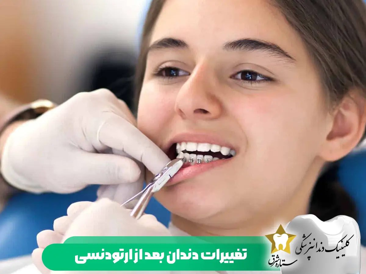 تغییرات-دندان-بعداز-ارتودنسی