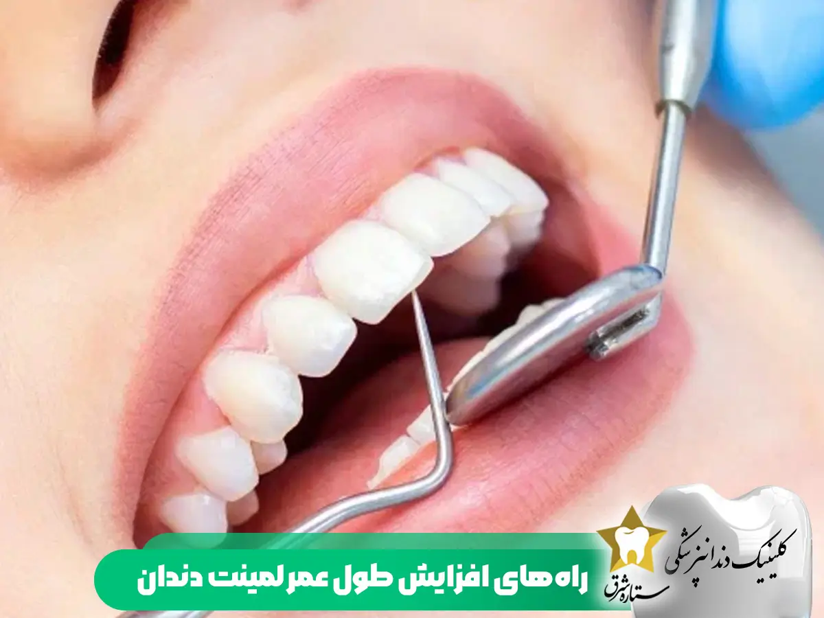 راه های افزایش طول عمر لمینت دندان