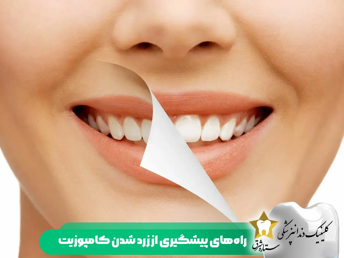 راه های پیشگیری از زرد شدن کامپوزیت دندان