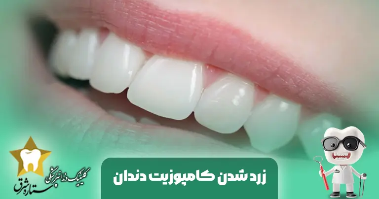 زردشدن کامپوزیت دندان