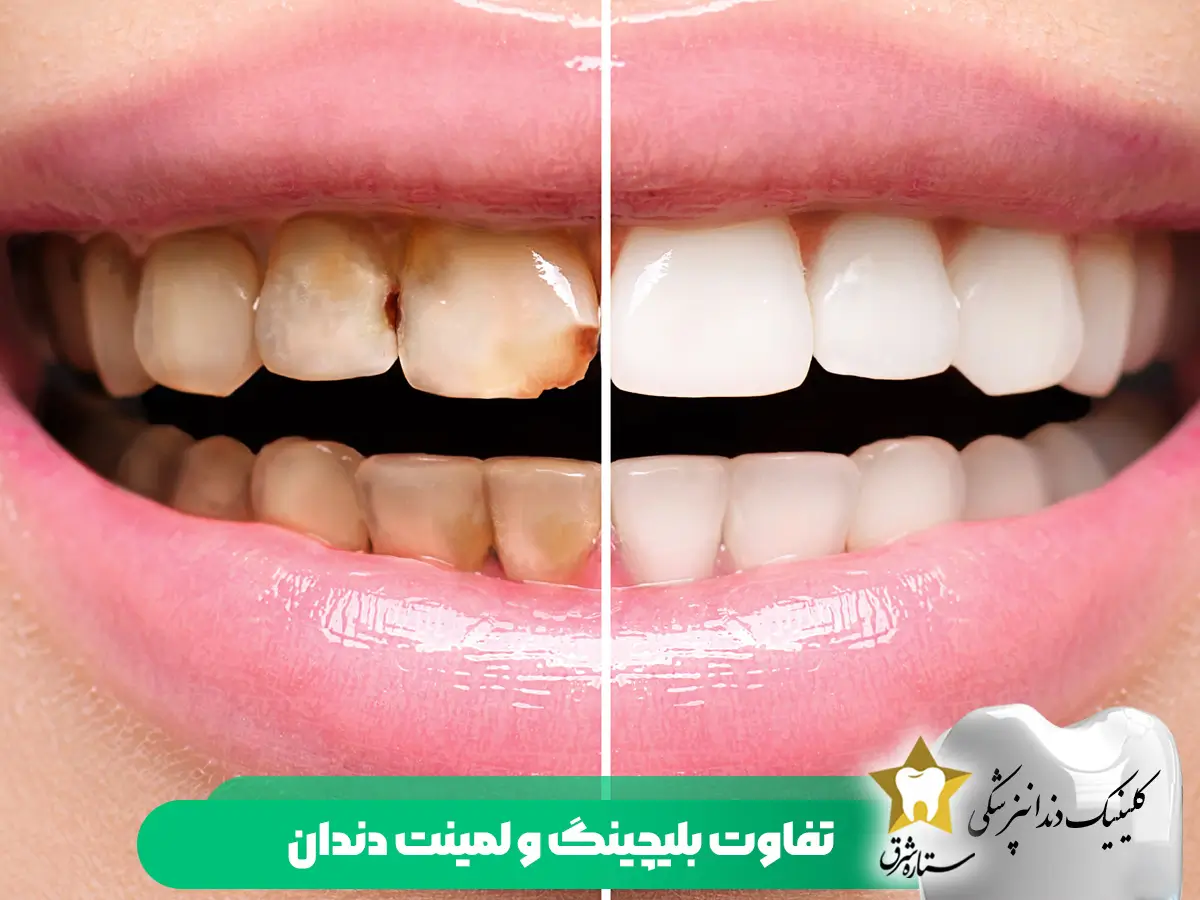 تفاوت-بلیچینگ و-لمینت دندان
