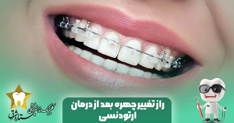 تغییر-چهره-بعداز-ارتودنسی