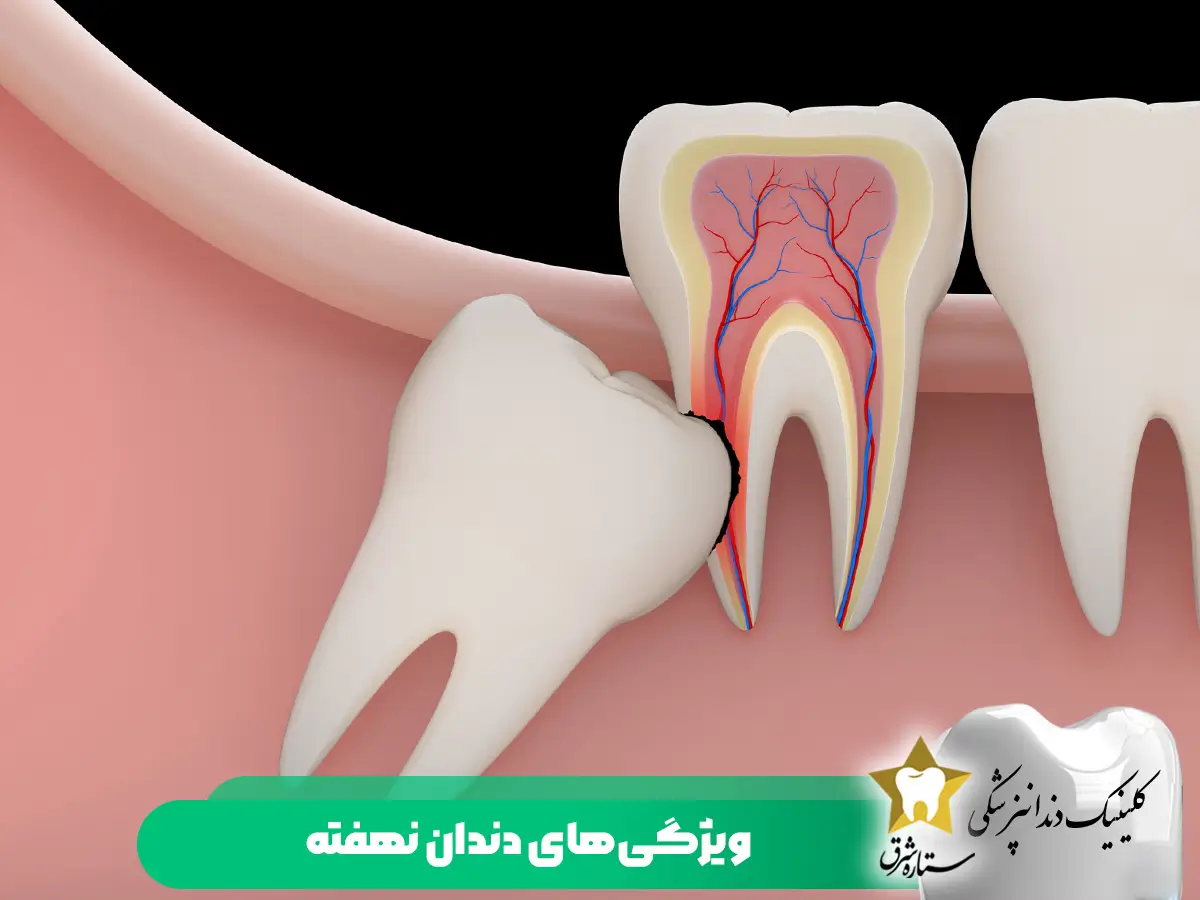 ویژگی‌های دندان نهفته