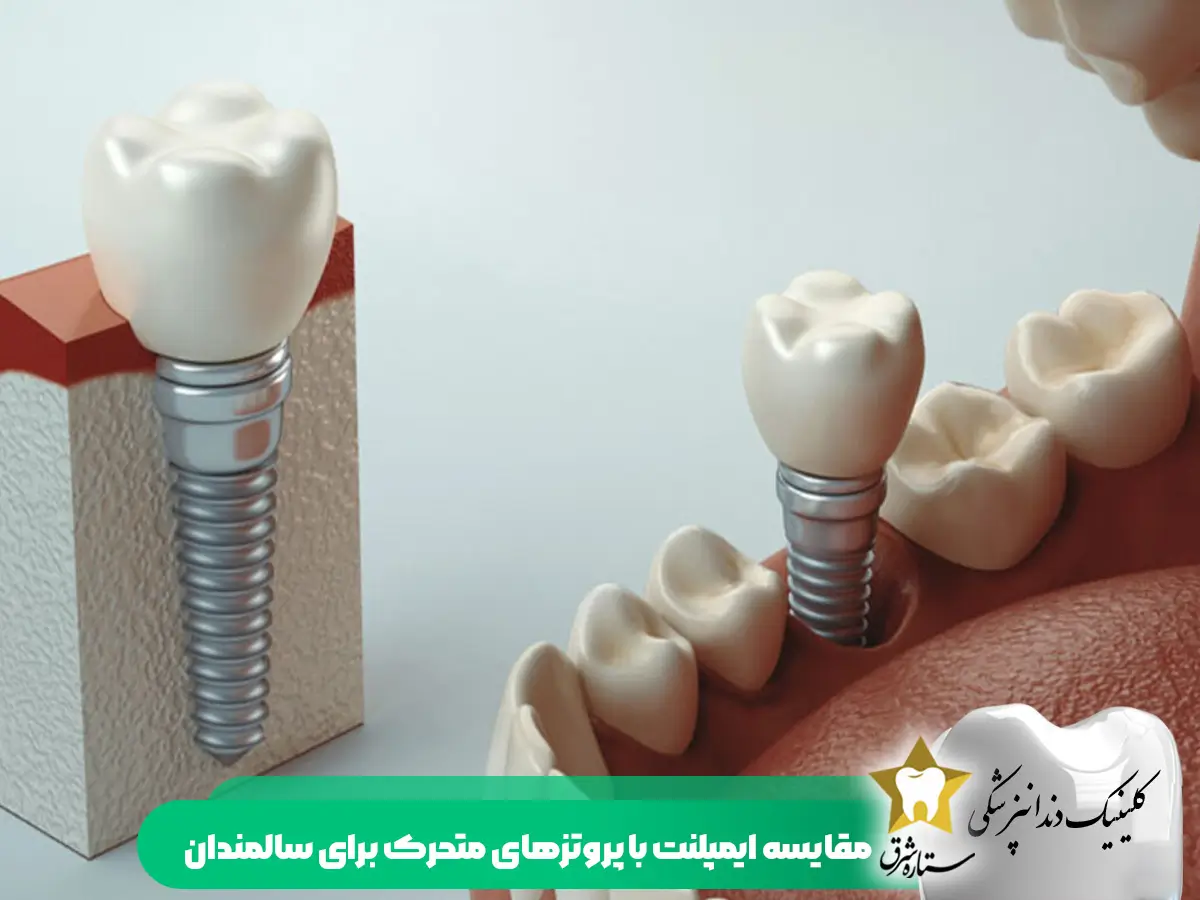 مقایسه ایمپلنت با پروتزهای متحرک برای سالمندان