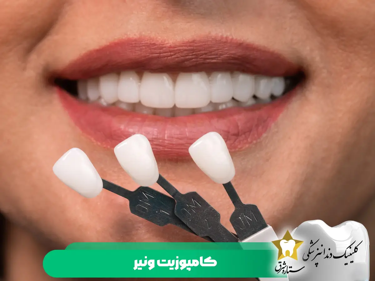 کامپوزیت ونیر