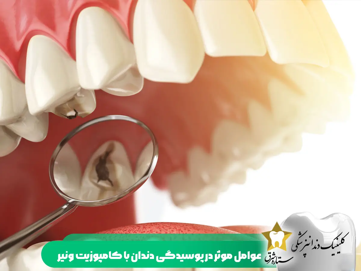 عوامل موثر در پوسیدگی دندان با کامپوزیت ونیر