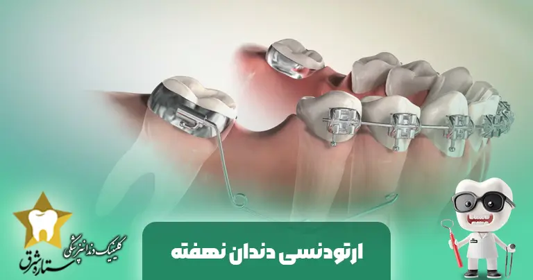 ارتودنسی دندان نهفته