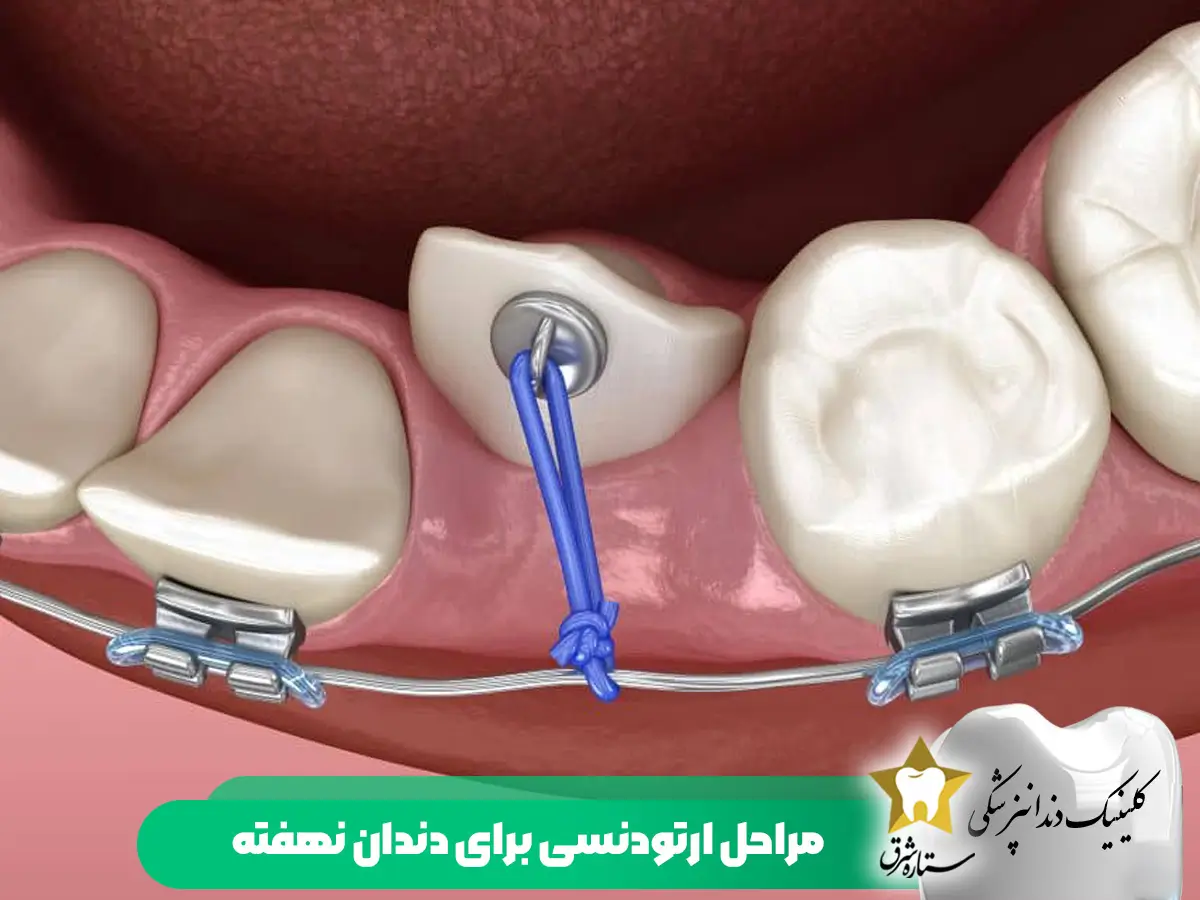 مراحل ارتودنسی برای دندان نهفته