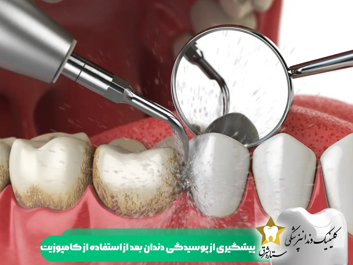 پیشگیری از پوسیدگی دندان بعد از استفاده از کامپوزیت ونیر