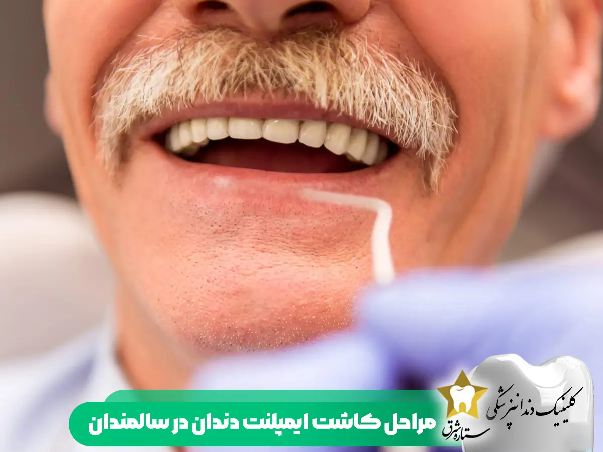 مراحل کاشت دندان ایمپلنت در سالمندان