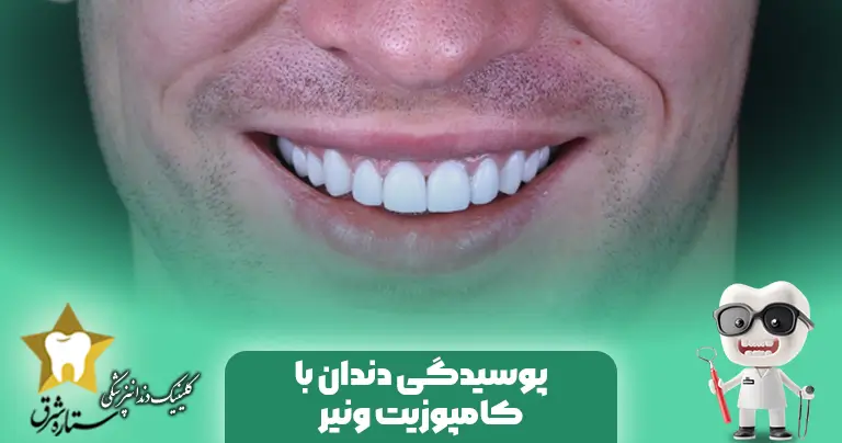 پوسیدگی دندان‌با کامپوزیت ونیر