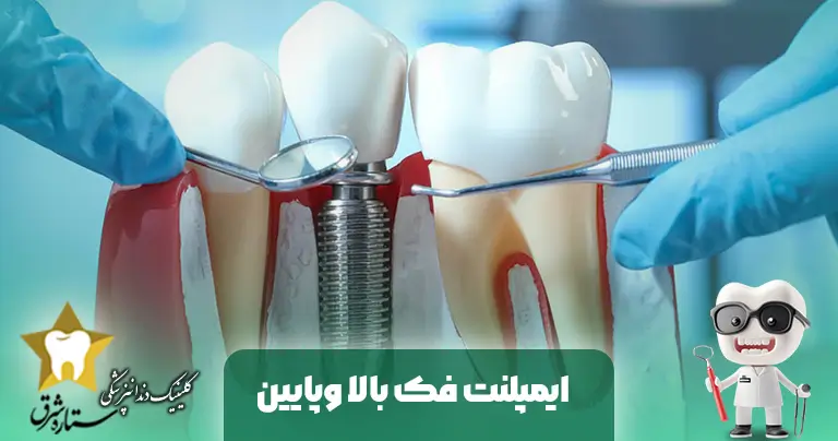 ایمپلنت فک بالا و پایین