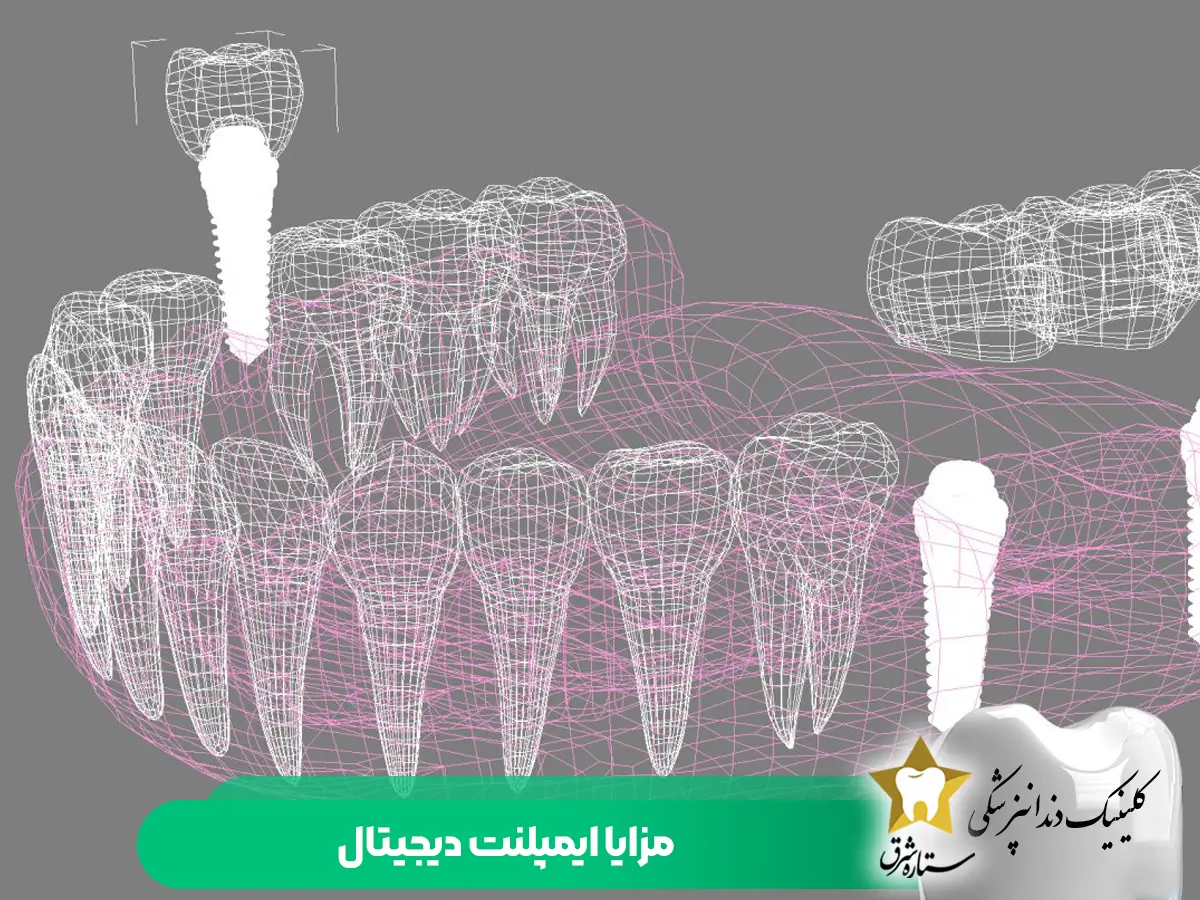 مزایا ایمپلنت دیجیتال