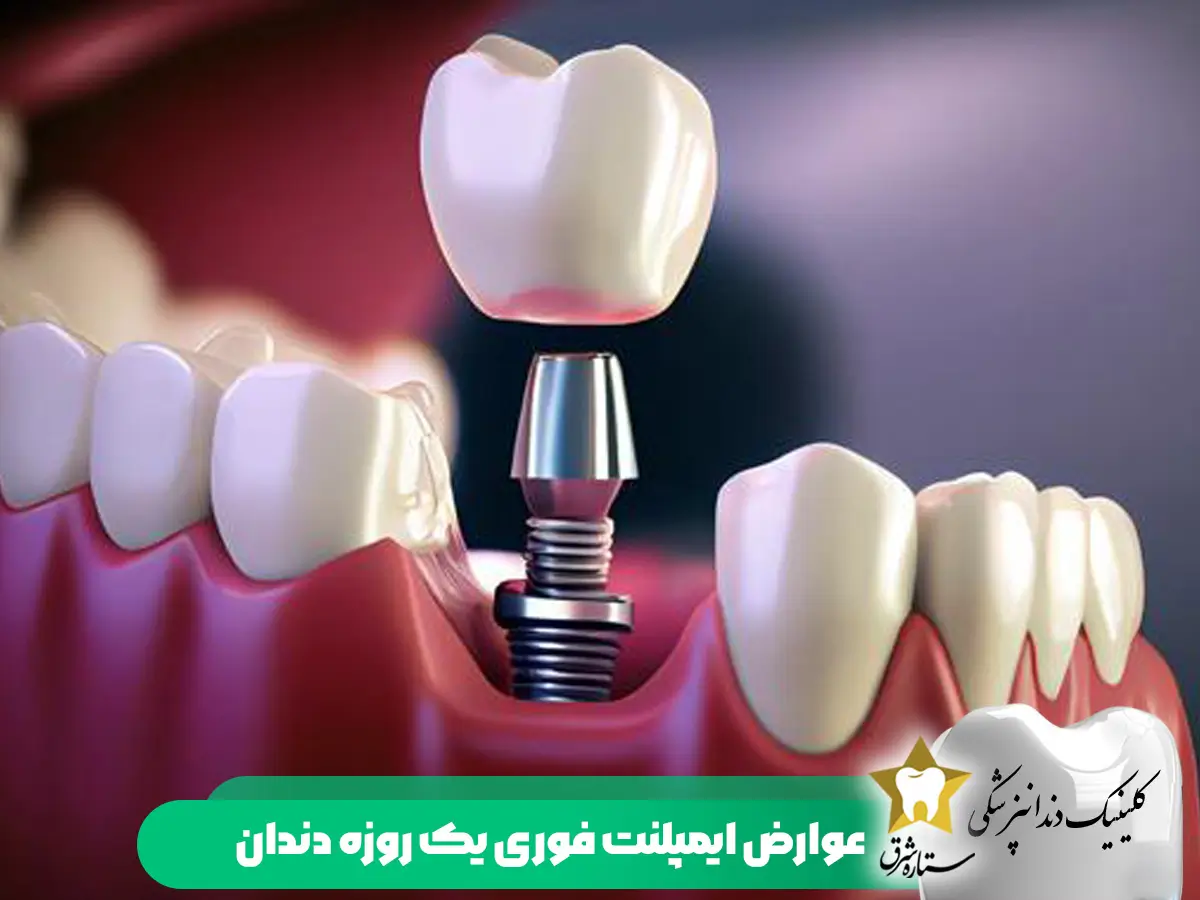 عوارض ایمپلنت فوری یک روزه دندان