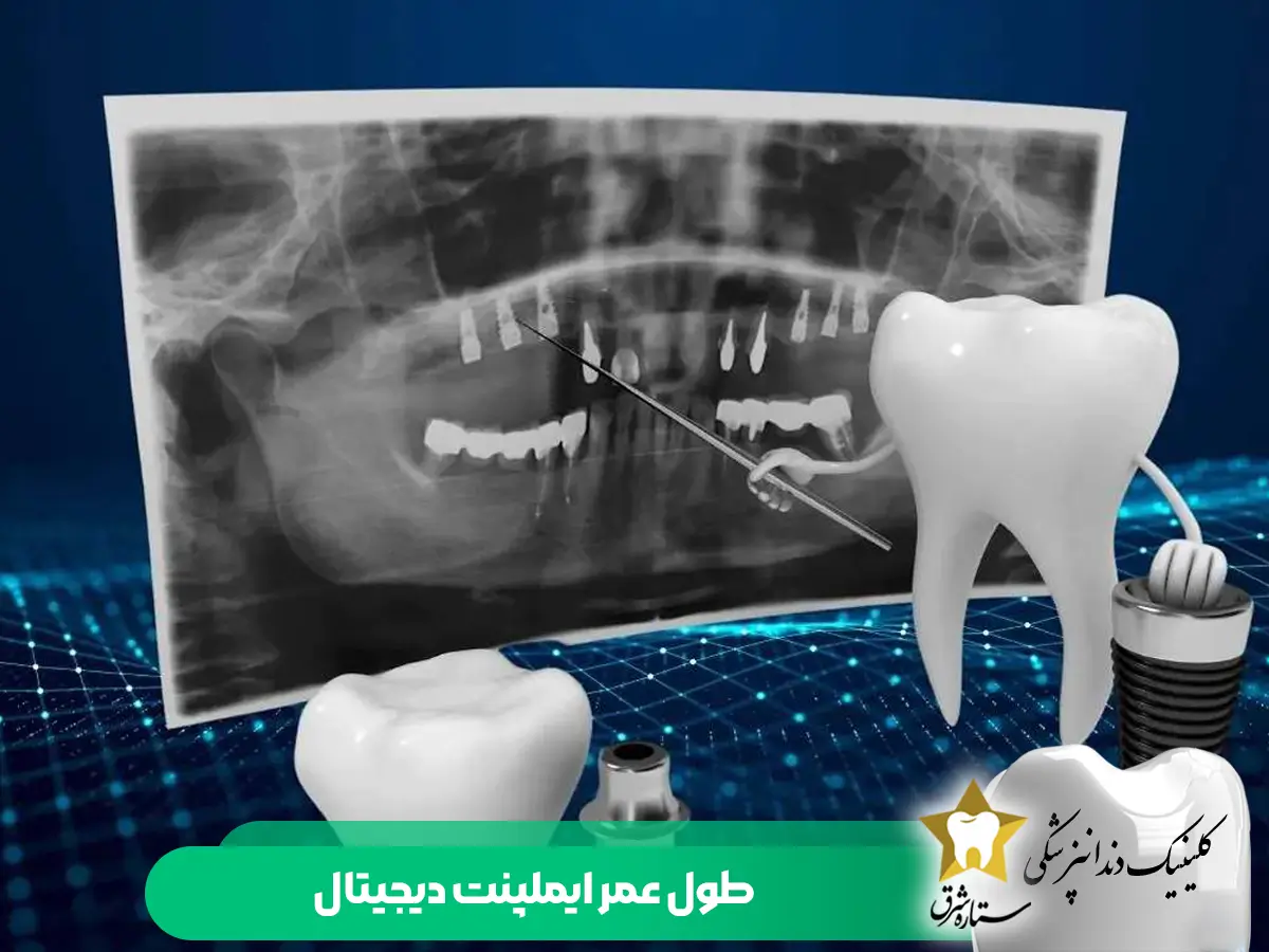 طول عمر ایمپلنت دیجیتال