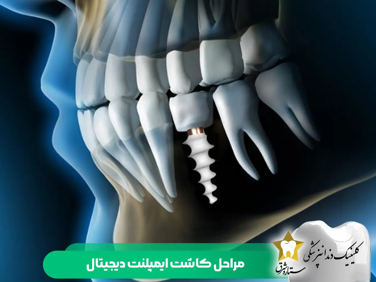 مراحل کاشت ایمپلنت دیجیتال