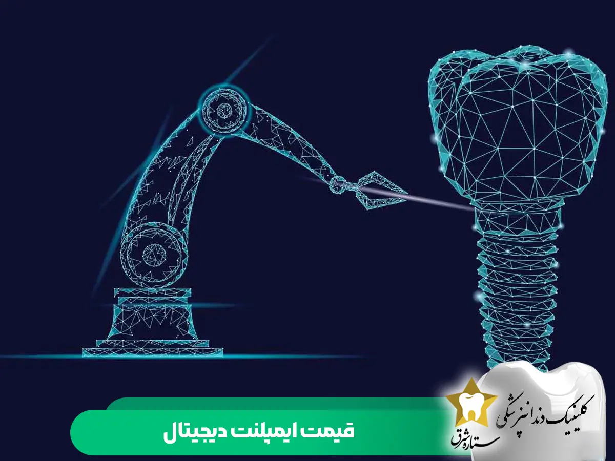 قیمت ایمپلنت دیجیتال