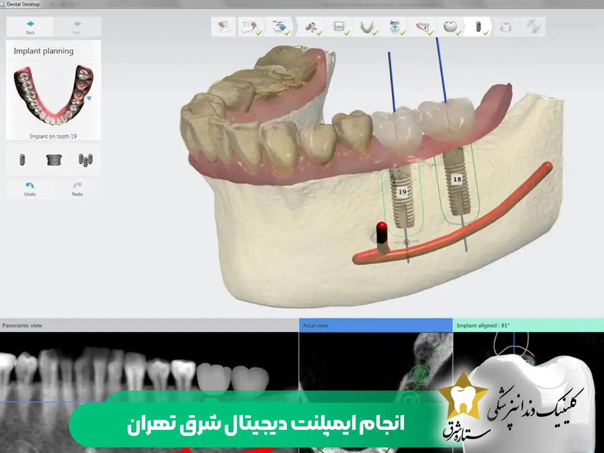 انجام ایمپلنت دیجیتال شرق تهران