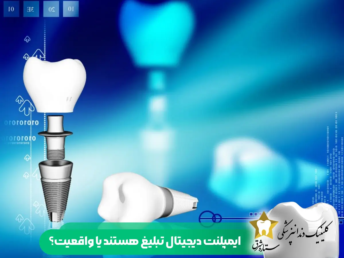 ایمپلنتهای دیجیتال فقط تبلیغات هستند یا واقعیت؟