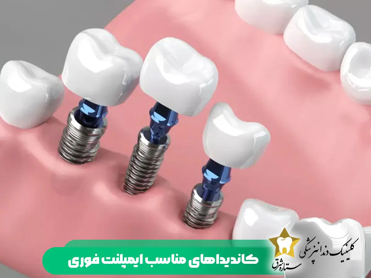 کاندیداهای مناسب ایمپلنت فوری