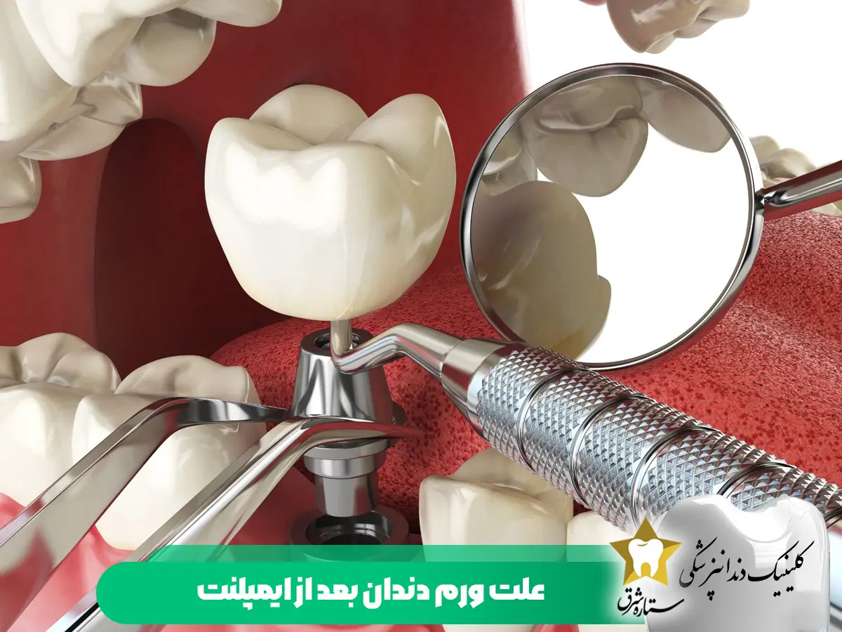 علت ورم دندان بعد از ایمپلنت