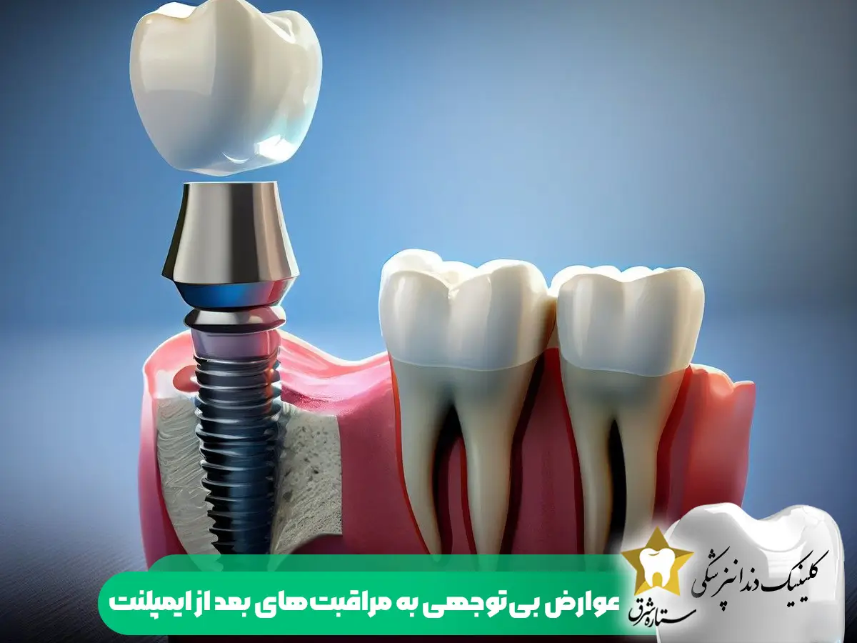 عوارض بی توجهی به مراقبت های بعد از ایمپلنت