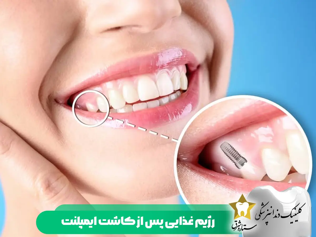 رژیم غذایی پس از کاشت ایمپلنت