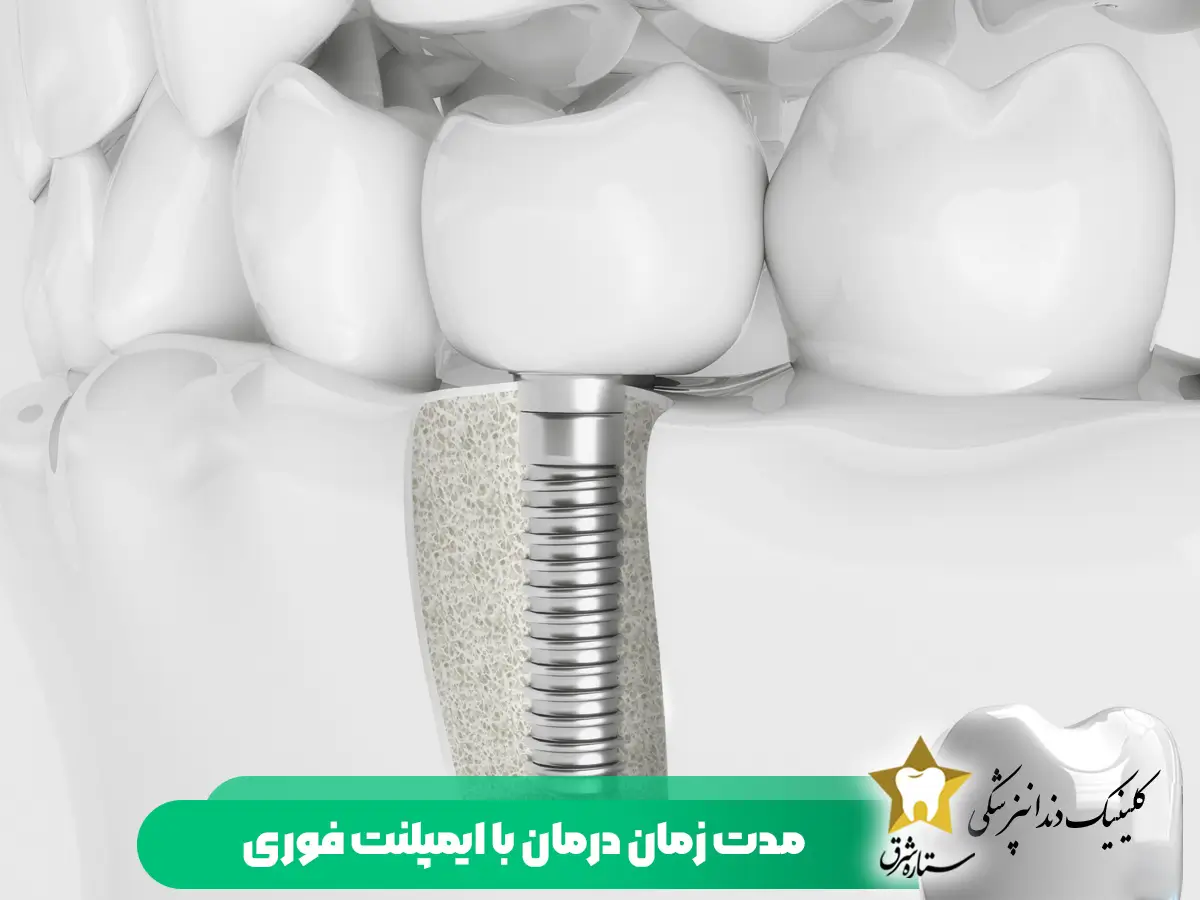مدت زمان درمان ایمپلنت فوری