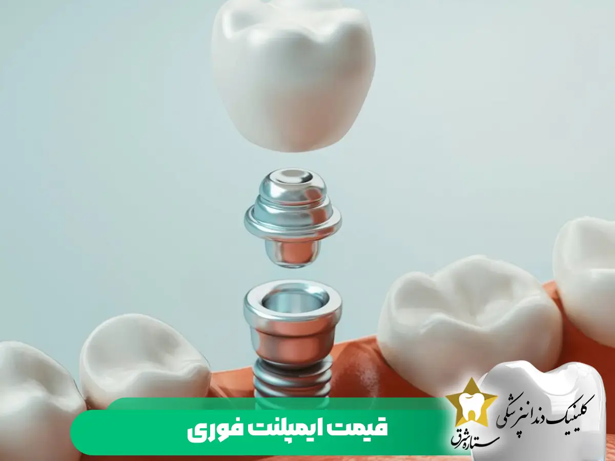 قیمت ایمپلنت فوری