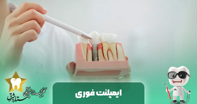 ایمپلنت فوری