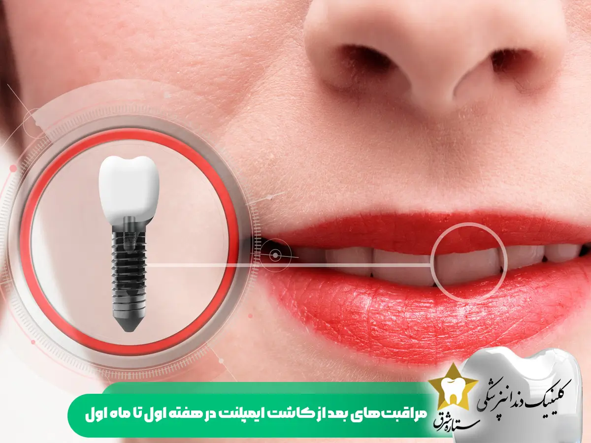 مرراقبت های بعداز کاشت ایمپلنت در هفته اول تا ماه اول
