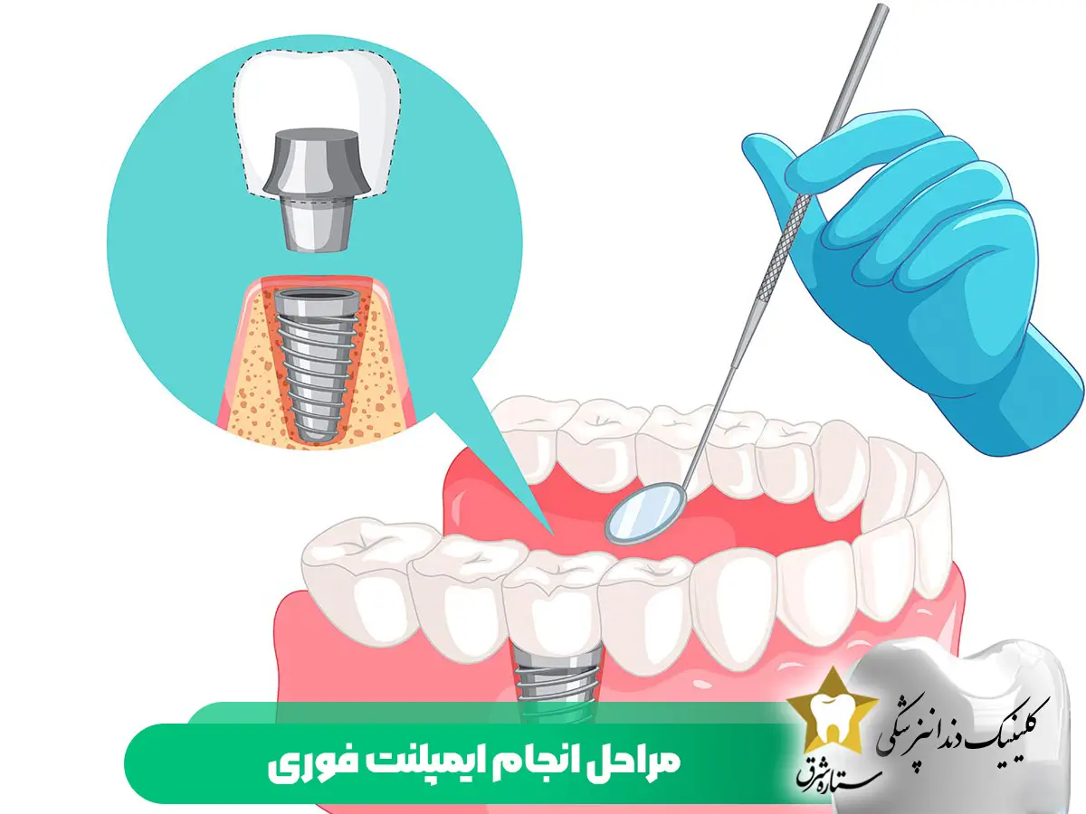مراحل انجام ایمپلنت فوری
