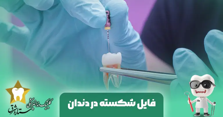 فایل شکسته در دندان