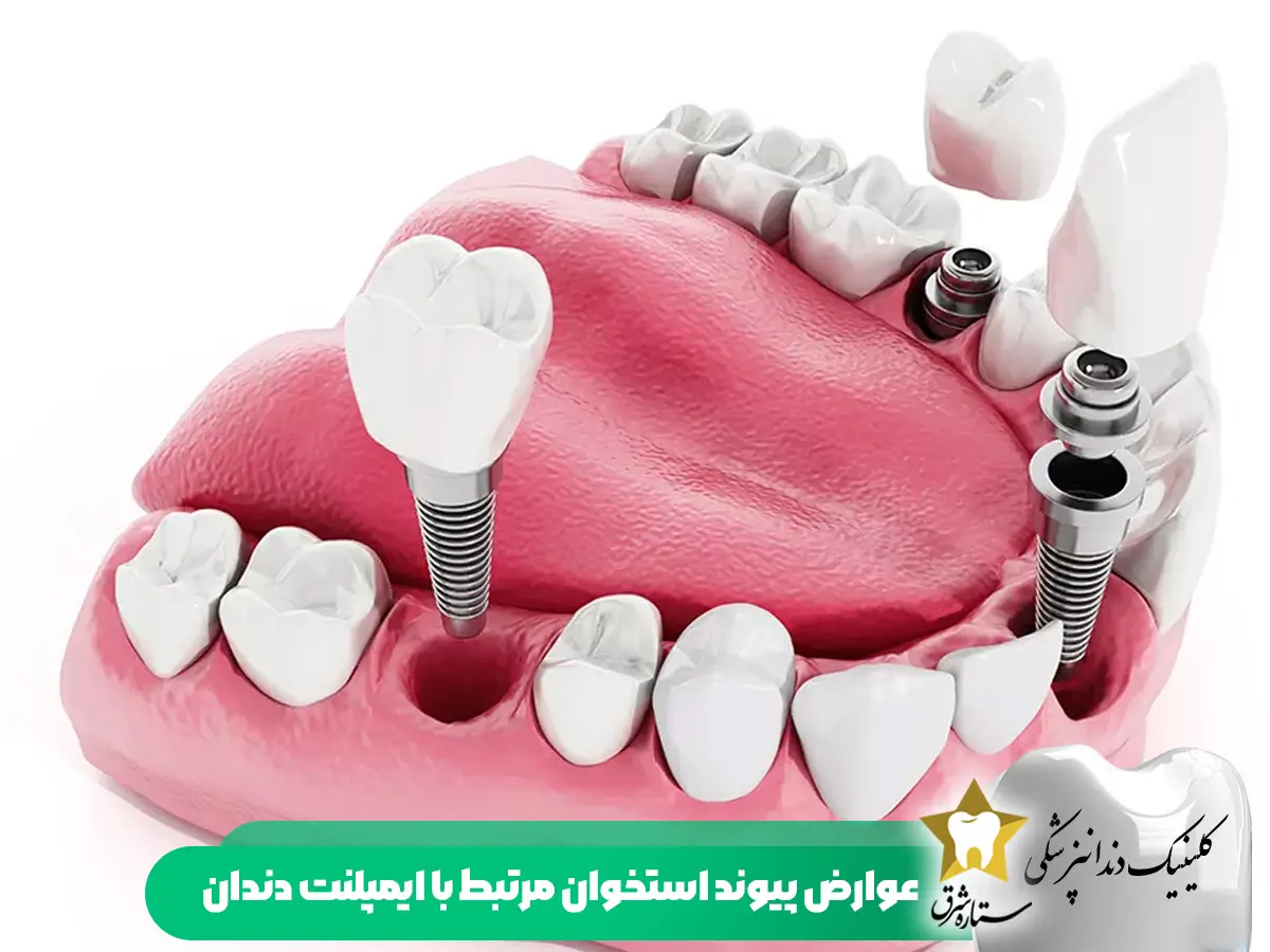 عوارض پیوند استخوان مرتبط با ایمپلنت دندان