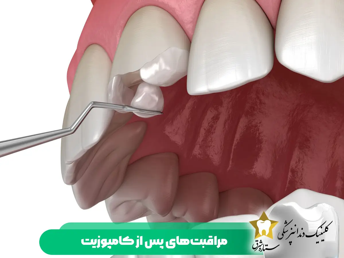 مراقبت های پس از کامپوزیت دندان